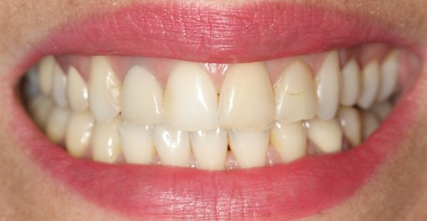 Coroas de porcelana e Lentes de Contato aps Clareamento