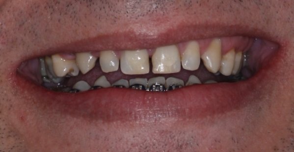 Fechamento de diastema com Resina composta