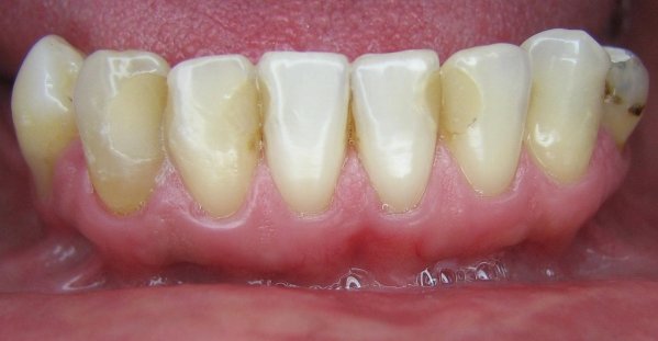 Fechamento de diastema com Resina composta