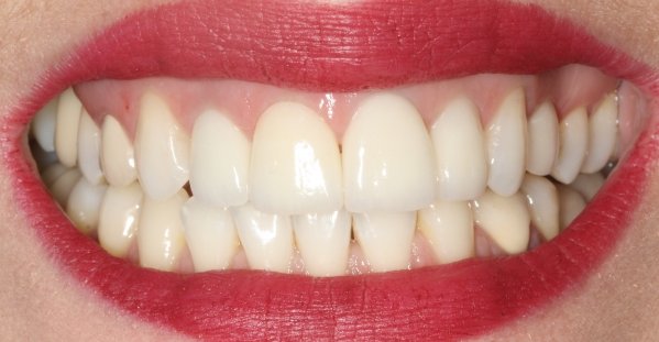 Coroas de porcelana e Lentes de Contato aps Clareamento