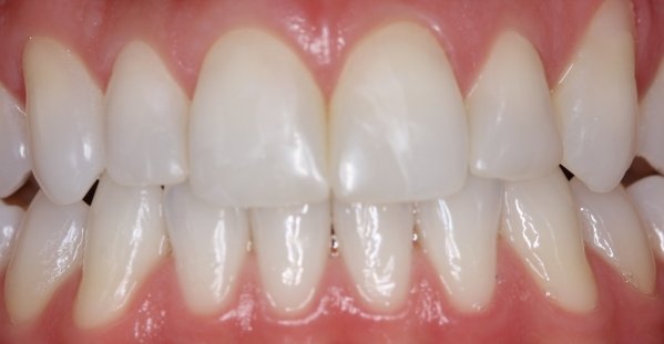 Fechamento de diastema com Resina composta