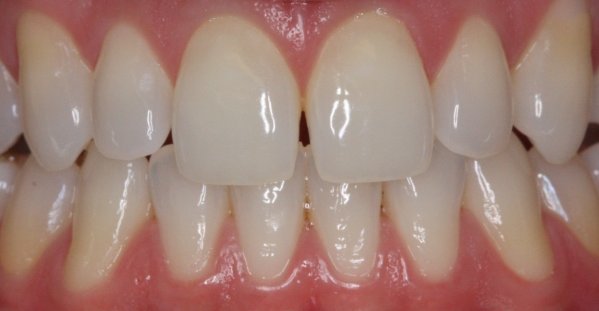 Fechamento de diastema com Resina composta