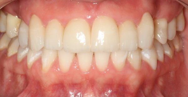Reabilitao esttica com implante, coroa de porcelana e facetas