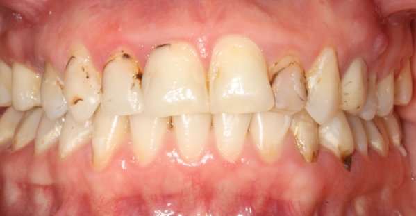 Reabilitao esttica com implante, coroa de porcelana e facetas