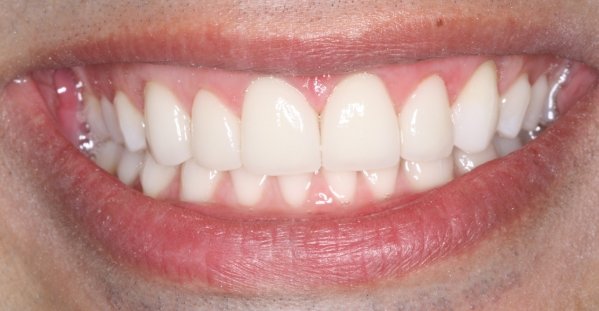 Gengivoplastia e Facetas de porcelana