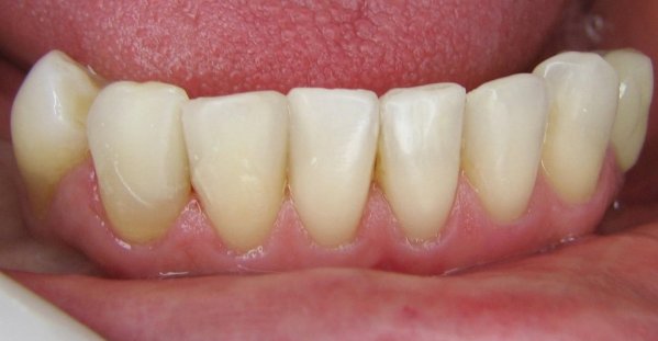 Fechamento de diastema com Resina composta