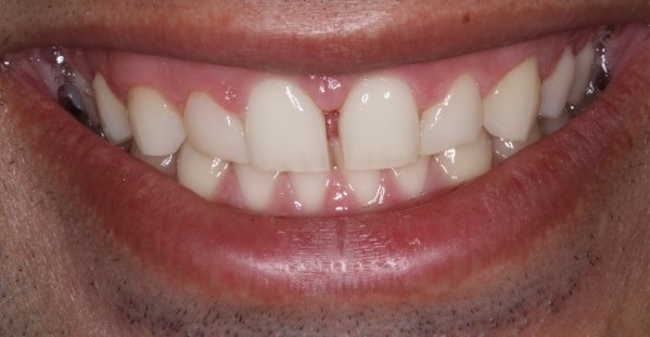 Gengivoplastia e Facetas de porcelana