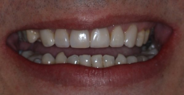 Fechamento de diastema com Resina composta